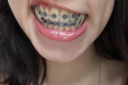 Amature_Braces