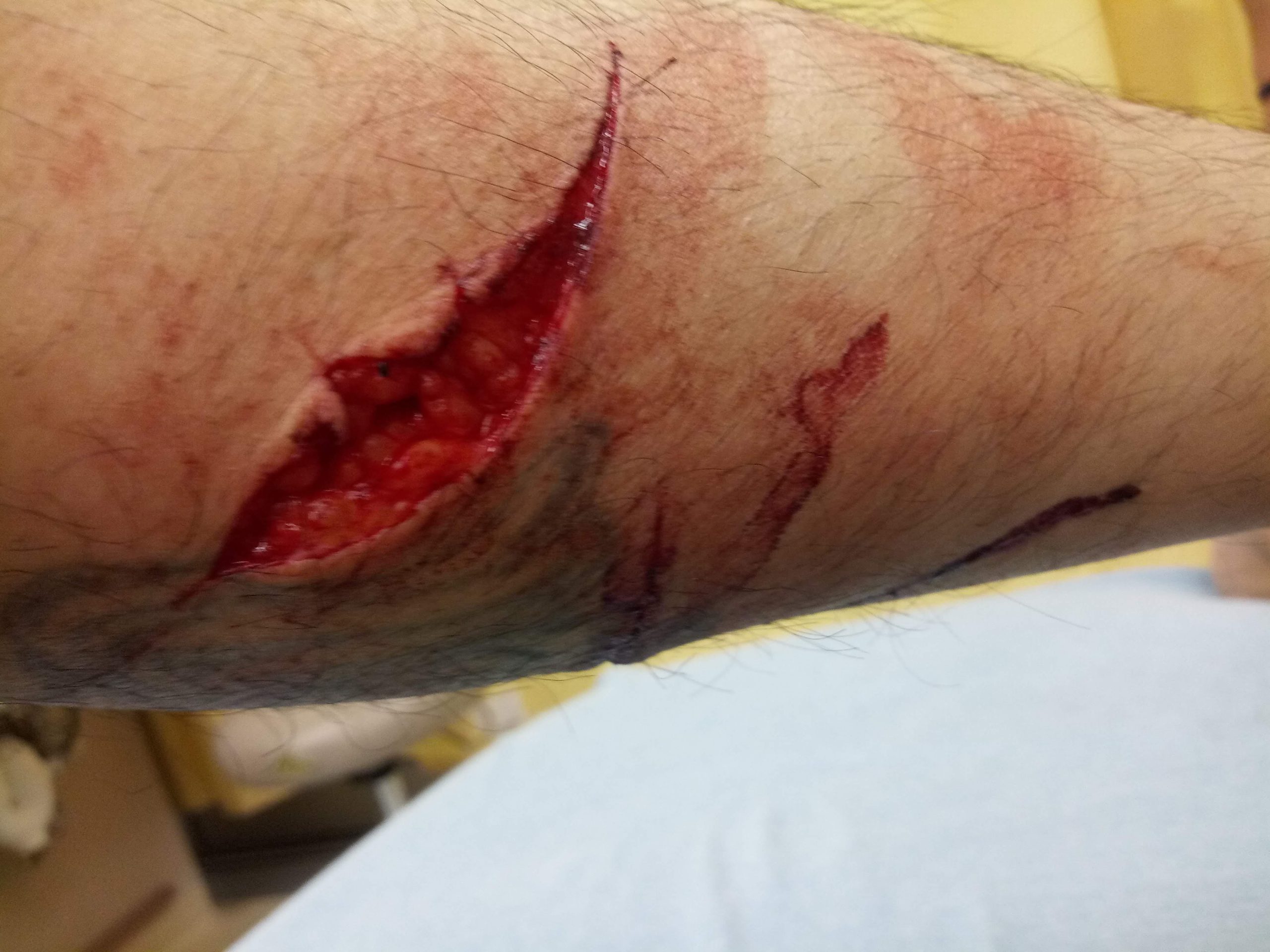 One of several gashes from when my ex tried to kill me