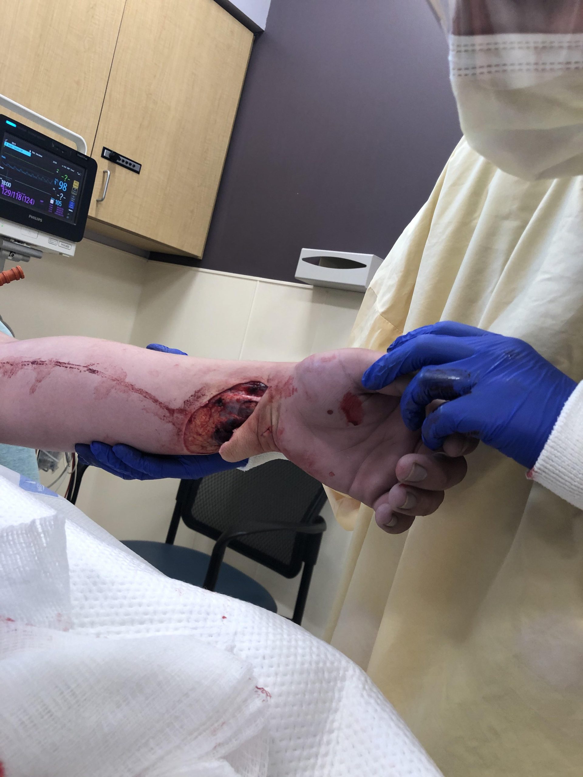 My wrist laceration from a couple weeks ago, caused by glass. Hit both arteries, tendons the whole works. Luckily one artery managed to close itself off and supply blood to my hand which is the only reason I kept it. Enjoy