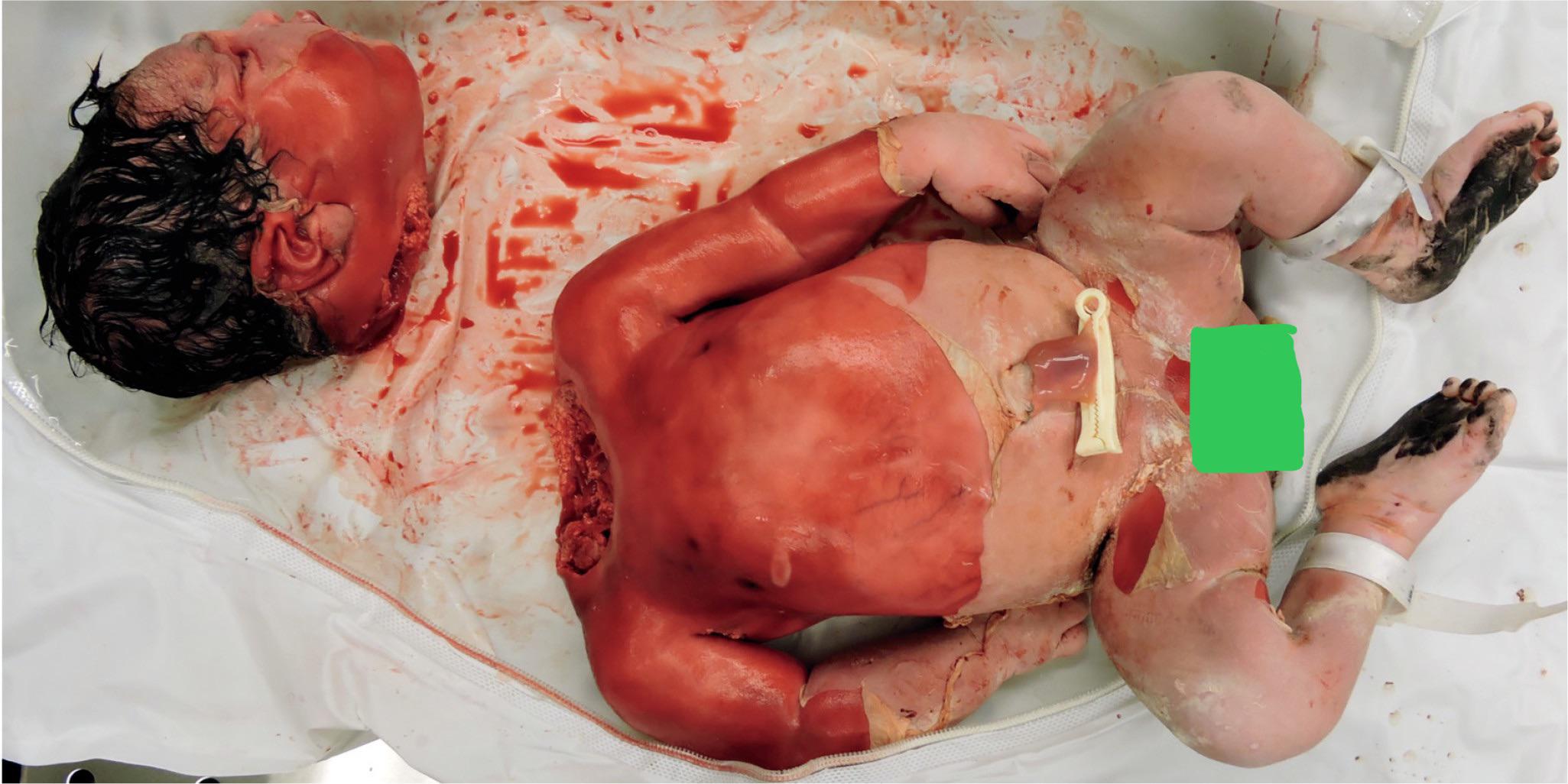 Accidental decapitation during birth