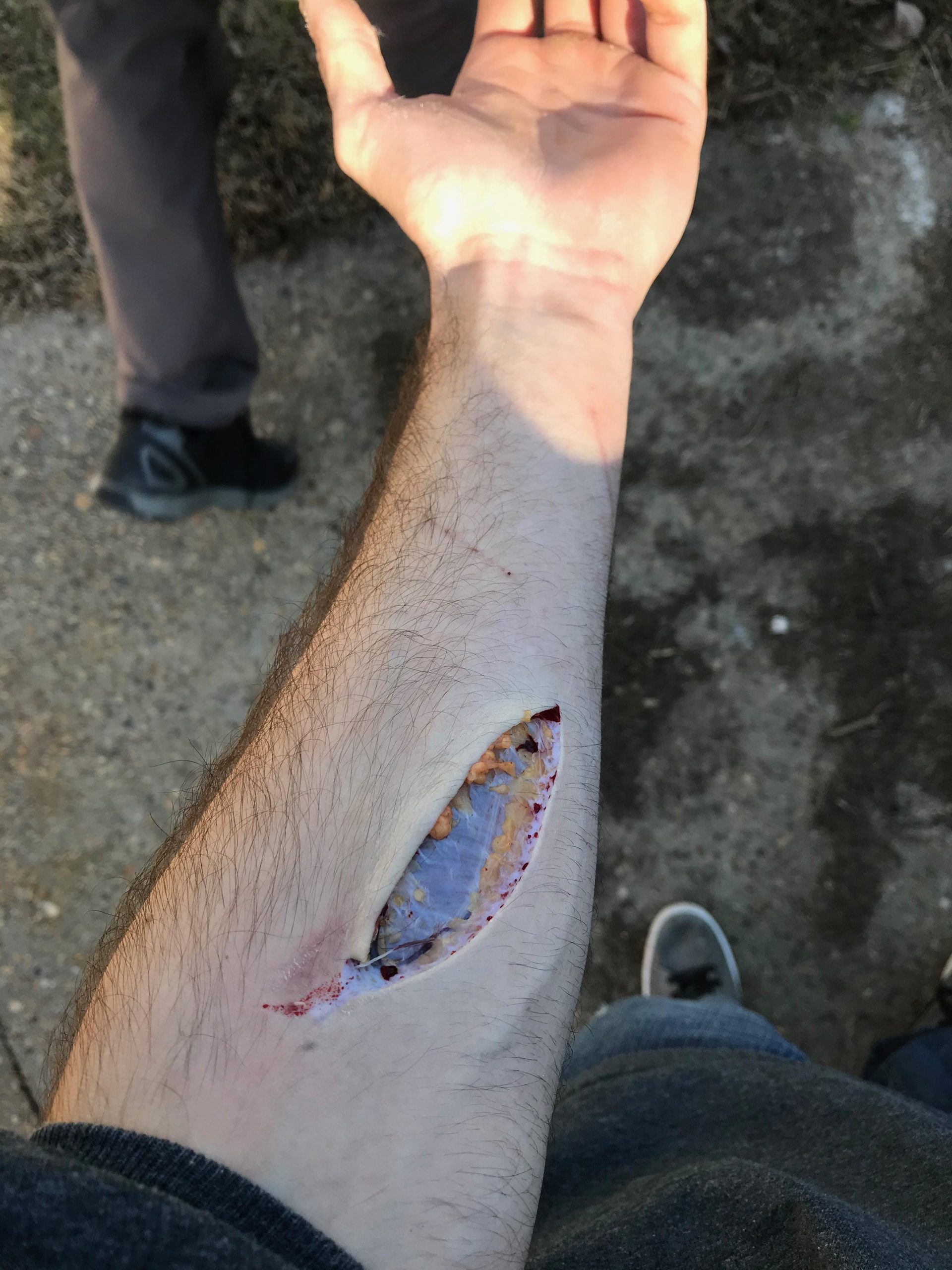 Small work injury. Other subs kept telling me this should be on here, makes sense cause doctors seem to be in love with this. I’ll let people in the comments describe what y’all looking at