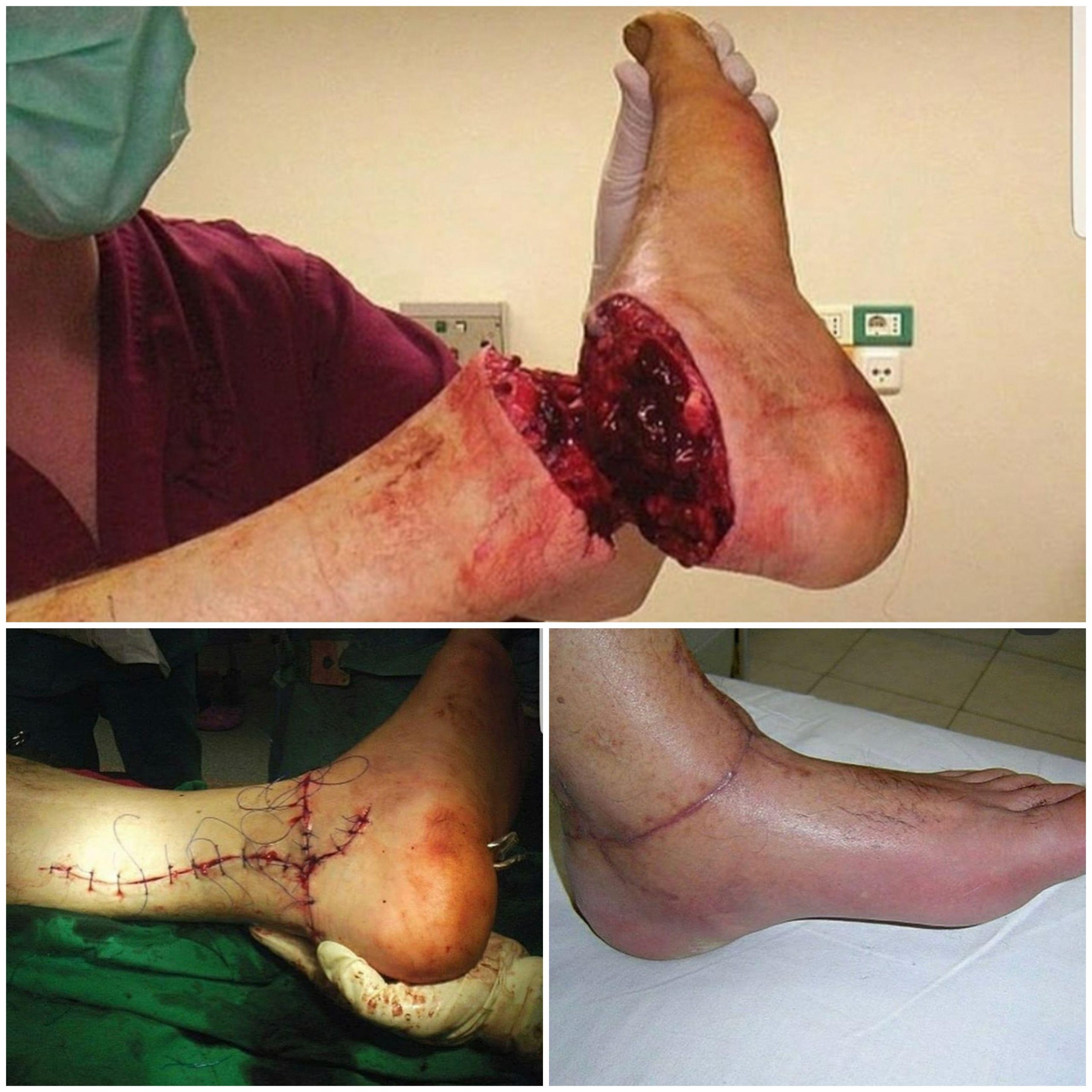 58 year man was admitted to Emergency Clinical Hospital Bucharest, aproximately 7 hours after his left leg got amputated by an electric saw. Replantation surgery was performed under general anesthesia for 9 hours. Later physical examinations presented no inflammations, no edema or pain syndrome!