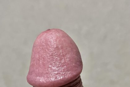 MicroPenis